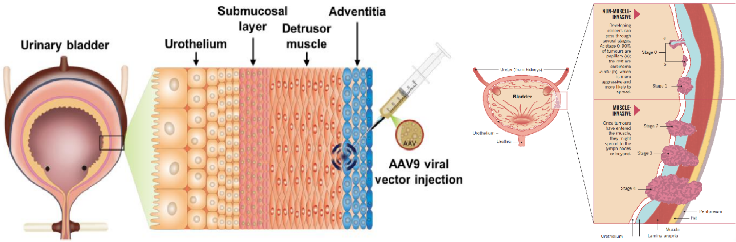 膀胱组织结构及癌变示意图