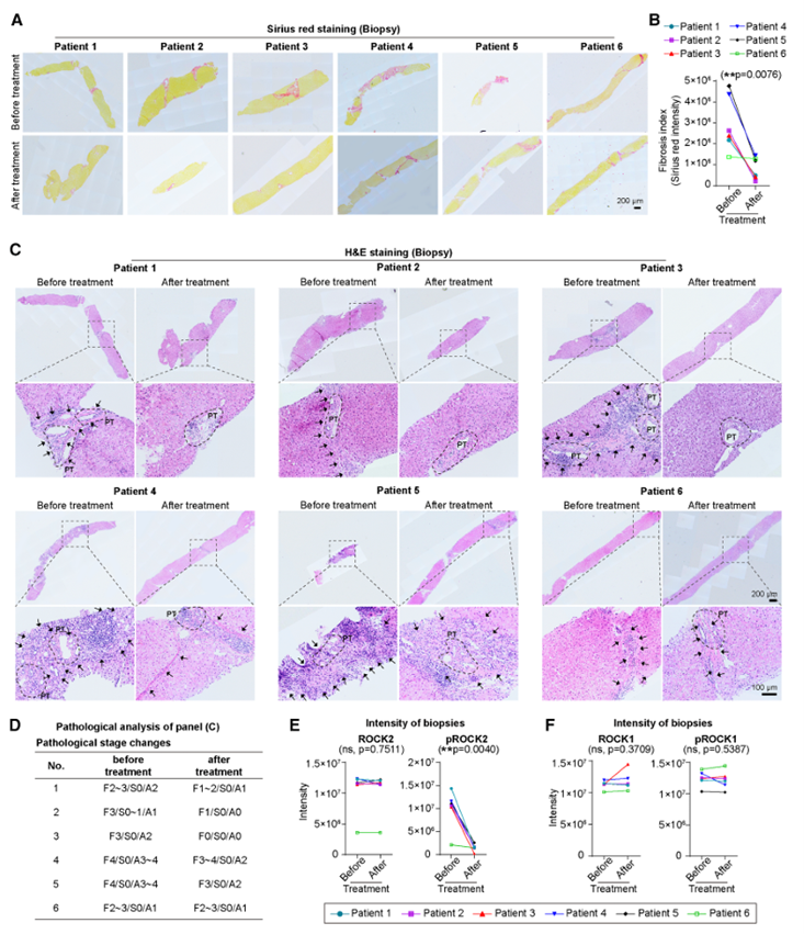 扩展临床试验活检样本表明TDI01通过抑制ROCK2活性改善纤维化